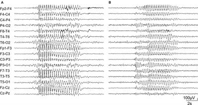 Case report: SLC6A1 mutations presenting with isolated absence seizures: description of 2 novel cases